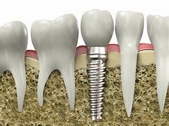 Dentalni implantati